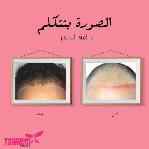 تجربتي مع عملية زراعة الشعر في مصر